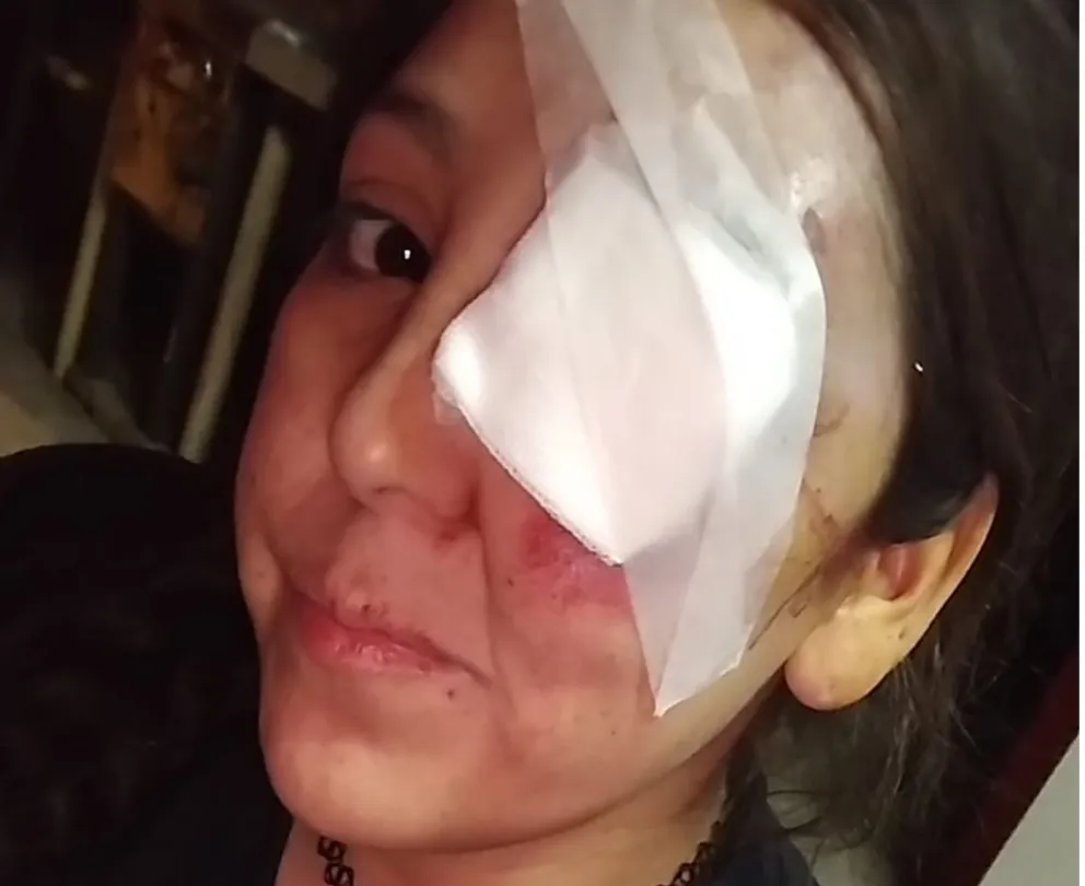 Una motociclista vivió un drama al caer en un pozo y casi pierde un ojo
