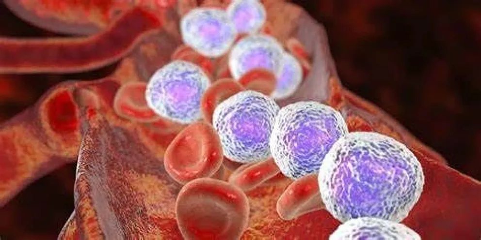 Más de 1.000 casos de leucemia linfocítica crónica diagnosticados por año en Argentina