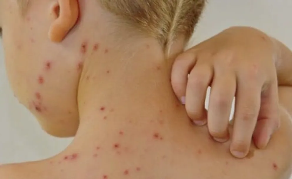 Un trabajo de campo evalúa la carga de la varicela por grupos de edad