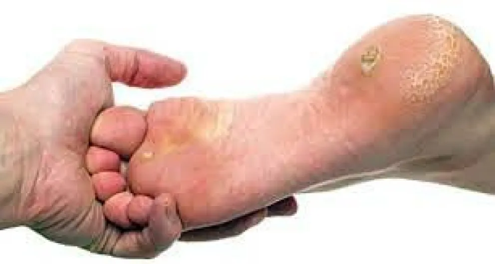 En el Día Mundial de la Diabetes en el 20 de Junio se enfocan en el pie diabético