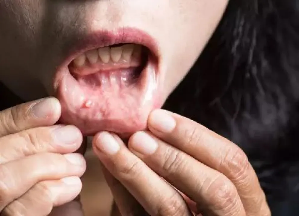 Día de la Lucha contra el Cáncer Bucal: todo lo que hay que saber