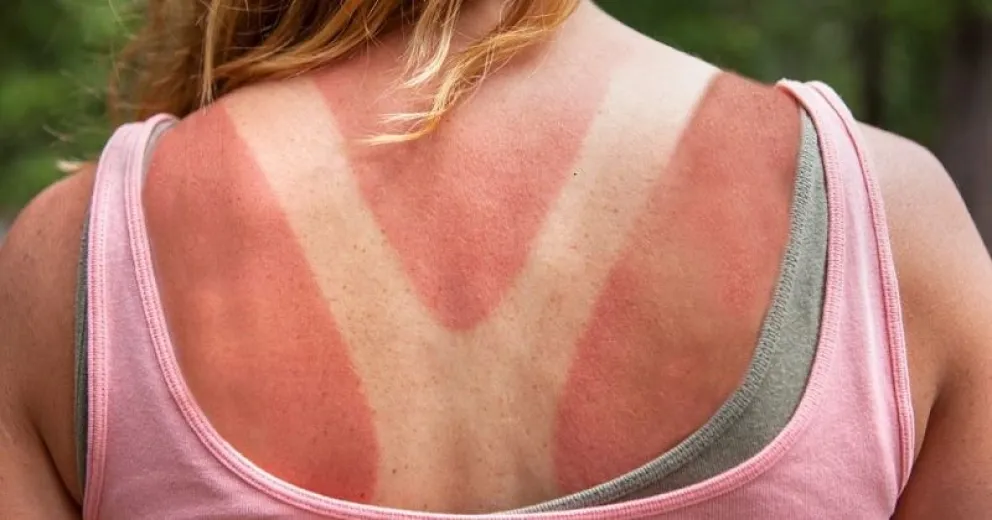 Los mejores remedios caseros para cuidar tu piel de quemaduras solares