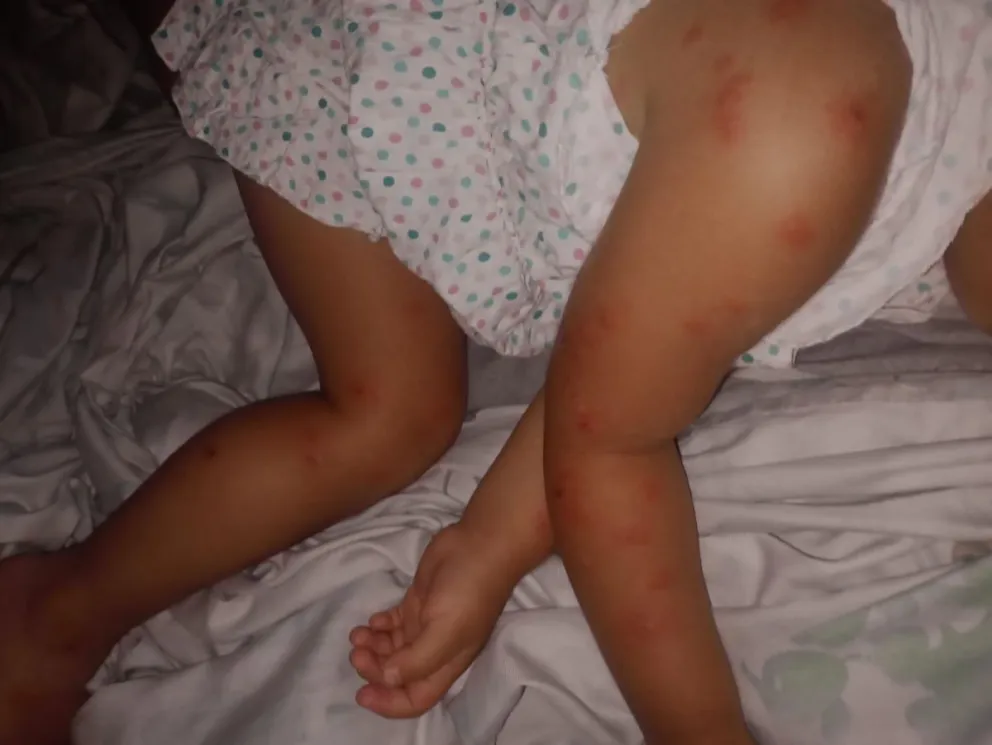 Tremendo: así quedó una nena de tres años por picaduras de mosquitos