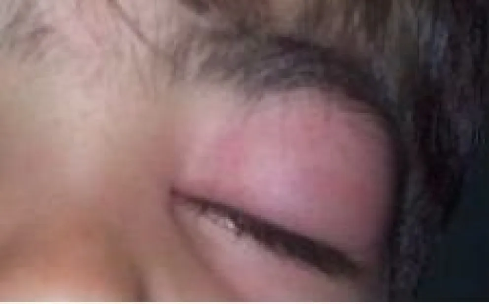 Impresionante: así quedó un nene en el barrio Guido por los mosquitos 