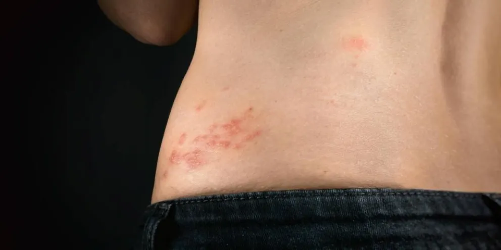 Herpes Zóster: una enfermedad a la que hay que prestarle atención 