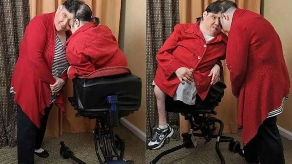 Murieron los gemelos siameses Schappel, récord de longevidad mundial