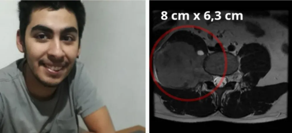  Llamado a la solidaridad por Esteban Gadan: tiene un tumor en la columna y debe operarse inmediatamente 