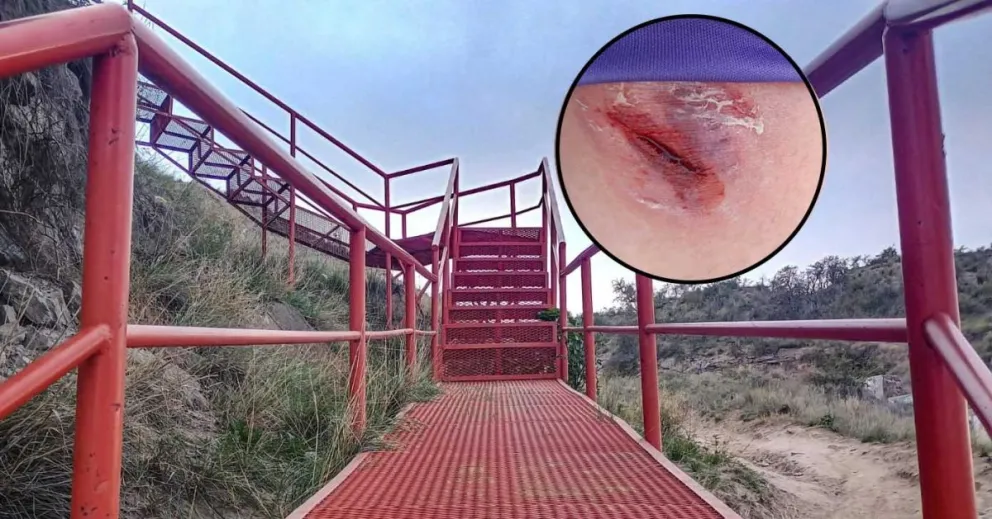 Salió a caminar y se accidentó: “Comparto mi caso y fotos para prevenir a nuestra comunidad”
