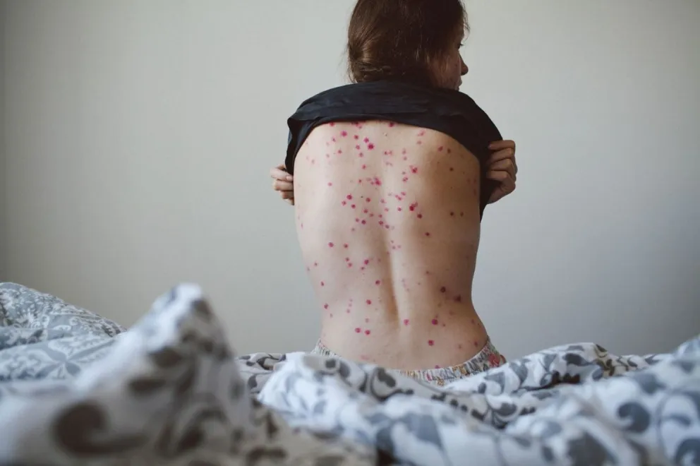 Viruela del mono en el país: cuántos casos hay y cuáles son los síntomas