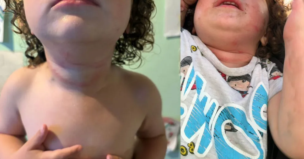 Las marcas que le quedaron a la pequeña (Foto: gentileza)