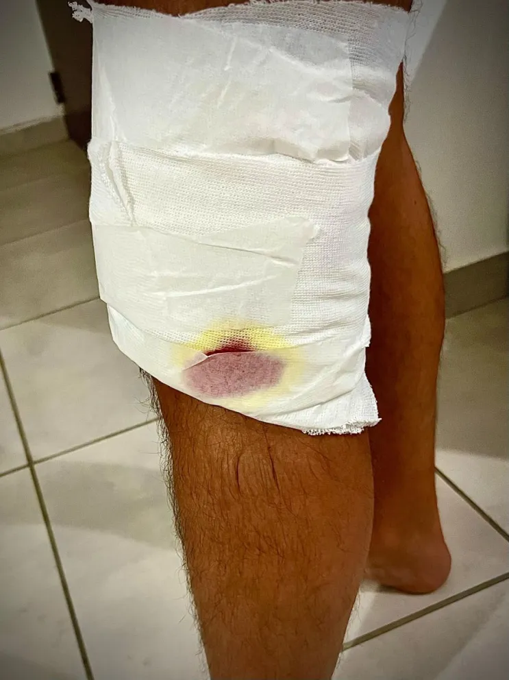 De inmediato le aplicaron un torniquete ante la abudante pérdida de sangre. Recibió varios puntos.