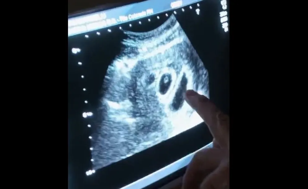 La ecografía en la que se reveló que había tres bebés en gestación.