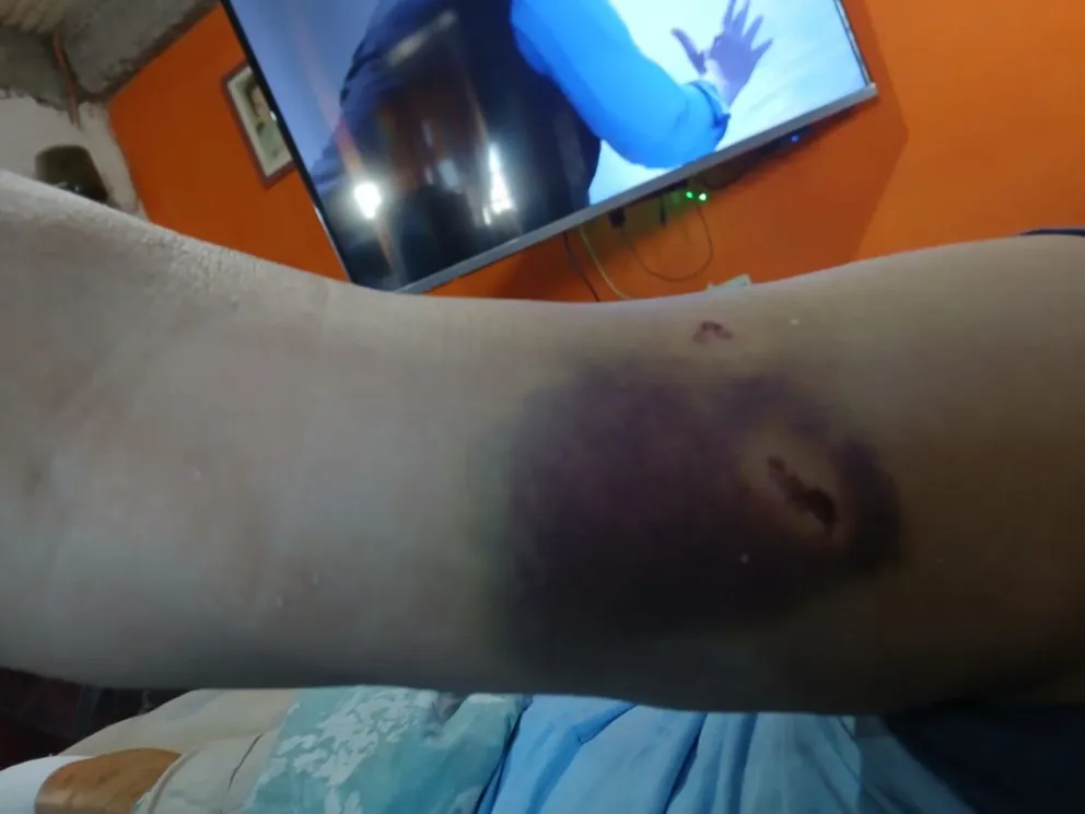 Así quedó el herido por los perros. Fotos proporcionadas por la misma víctima. 