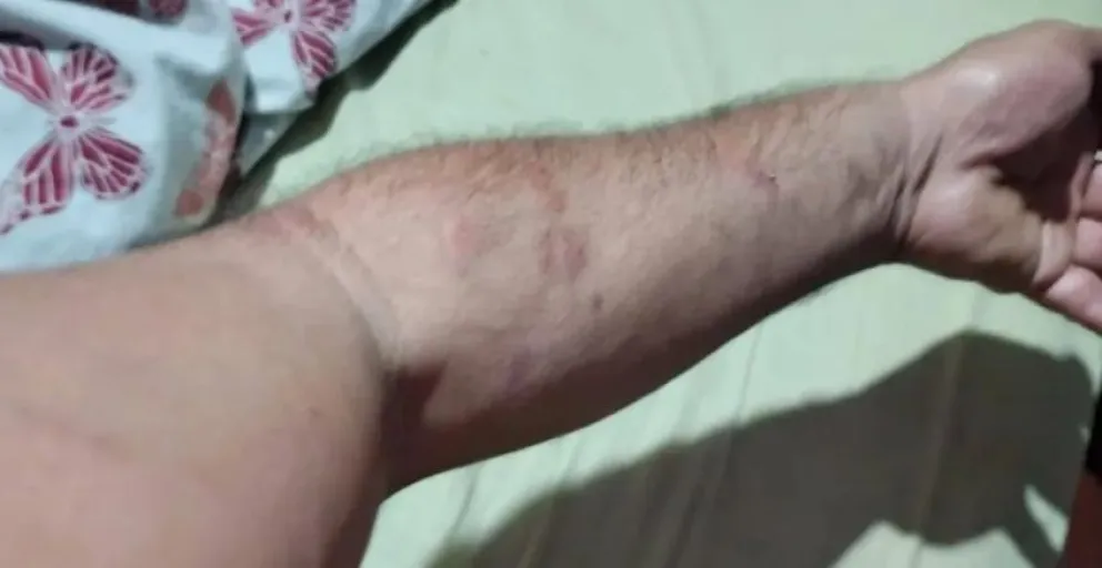 Las escoriaciones. Foto gentileza 7 en Punto.